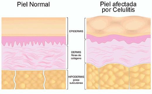 Tratamiento completo para combatir la celulitis