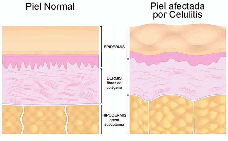 Tratamiento completo para combatir la celulitis