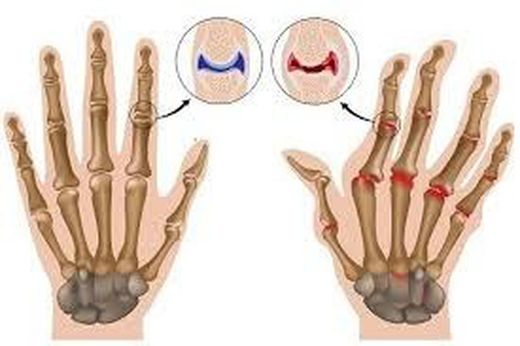 Perdida de Colágeno. A partir de los 40 dolores articulares y musculares, flacidez, arrugas, etc.