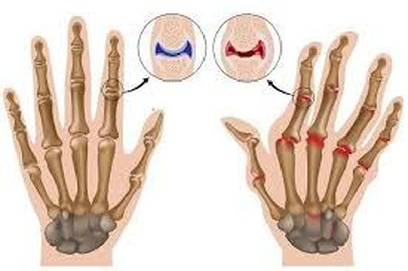 Perdida de Colágeno. A partir de los 40 dolores articulares y musculares, flacidez, arrugas, etc.